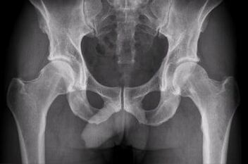 Opțiuni de diagnostic pentru artroza articulației șoldului