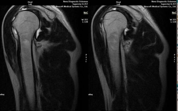 radiografie pentru a diagnostica artroza umărului
