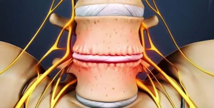 leziuni ale coloanei vertebrale datorate osteocondrozei