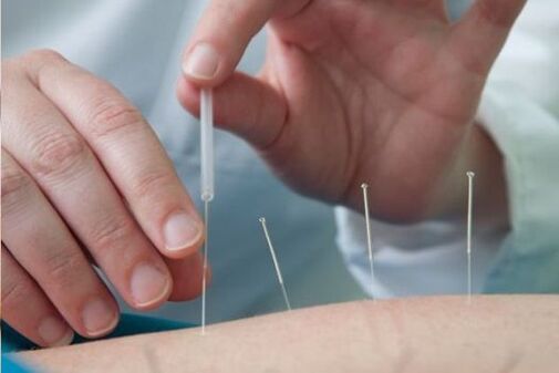 Acupunctura - o metodă de tratare a durerii în regiunea lombară cauzată de osteocondroză