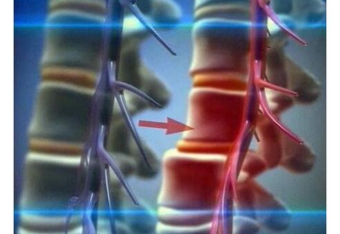 Strângerea terminațiilor nervoase în osteocondroza lombară