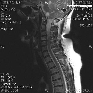 Dureri de spate si spondiloza coloanei cervicale